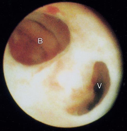 Image: Cystoscopy: Companion Patients 2, Urogenital Sinus Bladder (B) Vagina (V) Cystoscopy, camera introduced in to the urogenital sinus; T. Berrocal, P. Lopez, A.