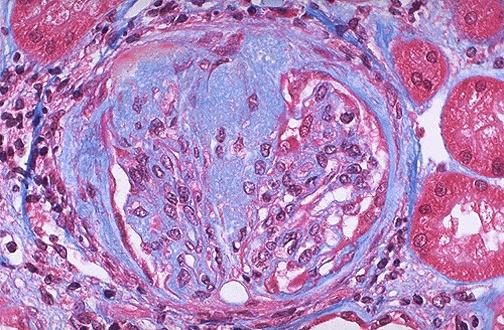 Trichrome image of glomerulus: Does this glomerulus look normal? If not, what structures appear altered? Are all glomeruli affected? Describe the progression of this disease.