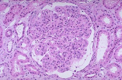 D. ACUTE POSTINFECTIOUS (POSTSTREPTOCOCCAL) GLOMERULONEPHRITIS CC/HPI: A seven year old female presents with her mother.