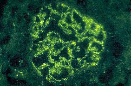 Immunofluorescence staining for IgG: Does this glomerulus look normal? If not, what structures appear altered? Describe the pathology of this disease. E.
