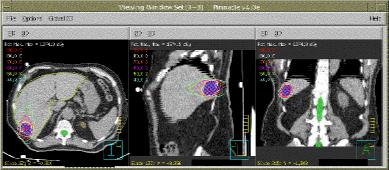 INTRODUCTION TO STEREOTACTIC BODY RADIOTHERAPY: (I) Physics and Technology (II) Clinical Experience & (III) Radiobiological Considerations and Future Directions Stanley H. Benedict, Ph.D., Danny Song, MD, and Brian D.