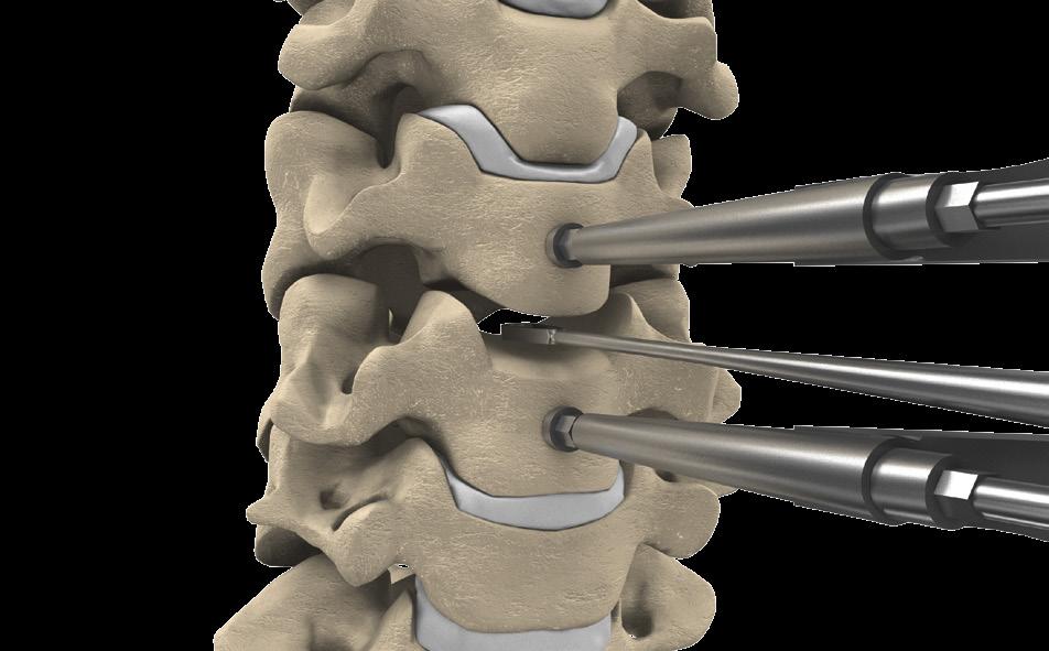 SURGICAL TECHNIQUE CP-ESP Indications The CP-ESP cervical disc prosthesis is designed for specific indications detailed in the sales literature, such as: Symptomatic cervical discopathy, defined as