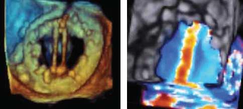3-D echocardiography and Doppler Assessment of the whole