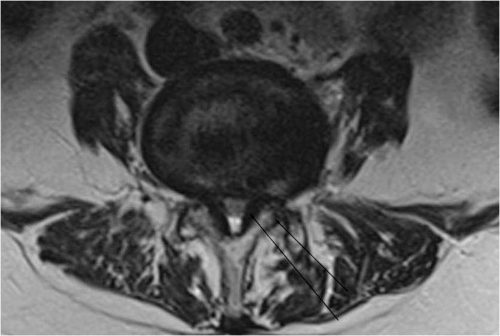 Fig. 3: grade 2 (25-50% SLIP) DEGENERATIVE SPONDYLOLISTHESIS at L3/4 with spinal canal stenosis Fig.