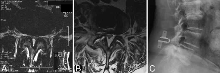 R. Davis et al. Fig. 1. A: Preoperative axial image obtained in a typical patient suitable for coflex device insertion.