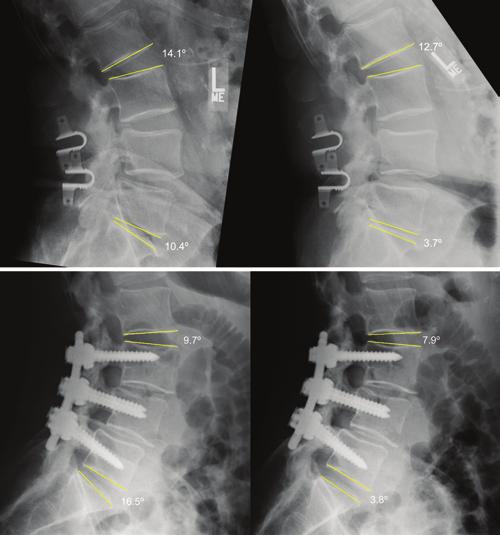 Spondylolisthesis treated with coflex stabilization of fusion Clinical Outcomes The ODIs were similar at baseline and at 2 years postoperatively, at which point the coflex cohort had an average score