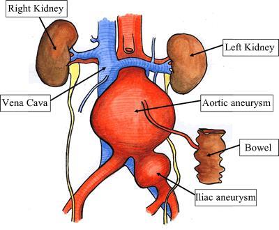 WHAT IS THE AORTA? The aorta is the largest artery (blood vessel) in the body. It carries blood from the heart and descends through the chest and the abdomen (tummy).