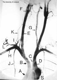 Intracranial arteries are rarely involved 11 Diagnostic Criteria Traditional (sensitivity, 93.5%; specificity, 91.2%; 3 0f 5 criteria must be met) 1. Age of onset of 50 years or older 2.