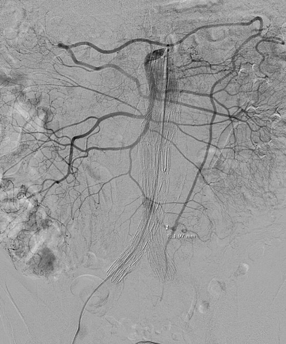 Fig. 4: Selective catheterization of the superior mesenteric artery with opacification of the inferior mesenteric artery through the Riolano's