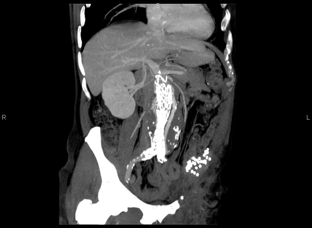 Fig. 10: Endoleak that surrounds the aorta in this coronal MIP reconstruction.