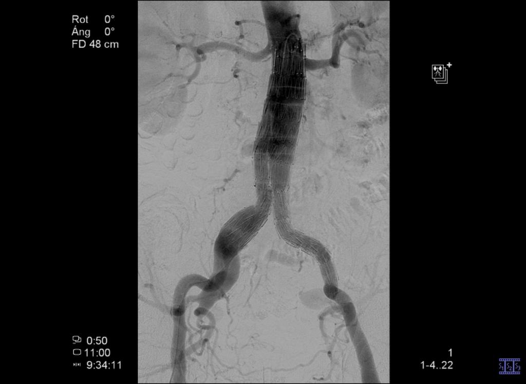 Fig. 3: Late opacification of the aneurysm sac in the left hypogastric artery