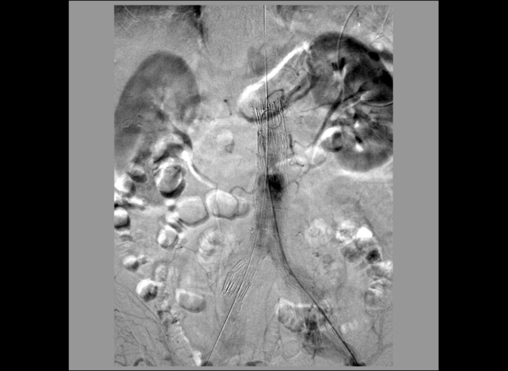 Fig. 5: Late opacification of the aneurysm sac through the