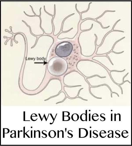 Parkinson s Disease Dementia & Dementia with Lewy