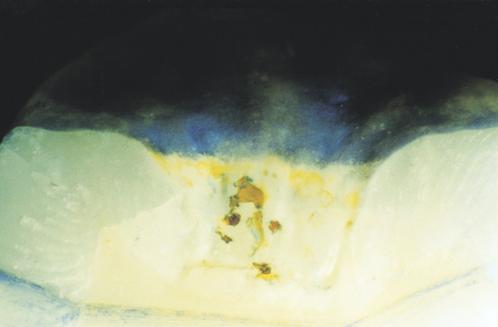 OCCLUSAL SURFACE Fig 3. A fissure wall in a split tooth illustrating the etch resistant zone which did not take up the stain.