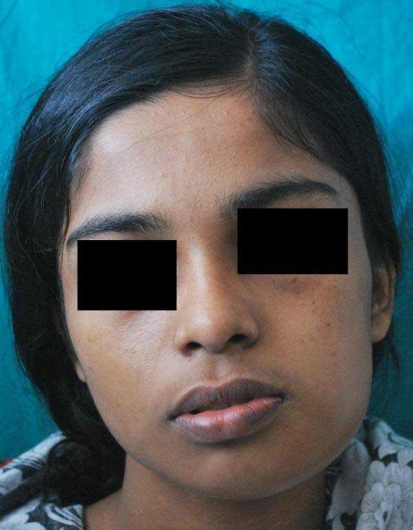 CASE REPORT A 17-year-old-girl reported to Department of Oral Medicine and Radiology with a chief complaint of painful swelling over the left lower jaw of 2 months duration.