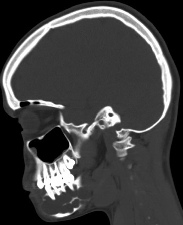 mandible with anterior unilocular radiolucency crossing midline. Fig.