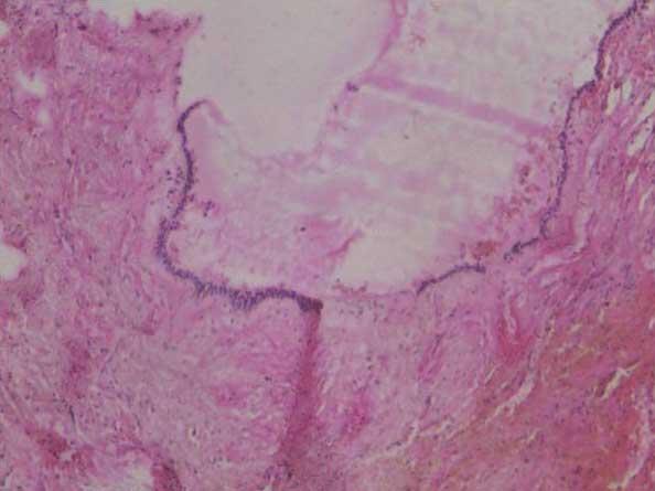 H & E stained section shows primitive epithelial lining with focal areas of mural ameloblastomatous proliferation into the connective tissue stroma (10 X). Fig. 4B.