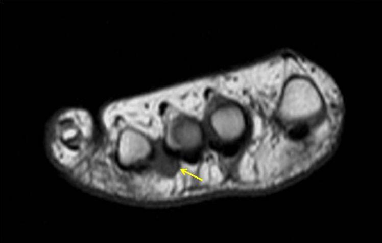 NERVE ABNORMALITIES Figure 09: MORTON S NEUROMA. Female 38-year-old.