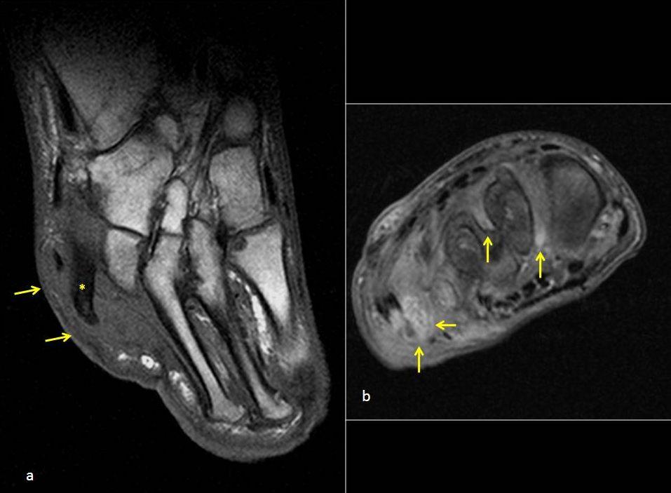 SOFT-TISSUE ABNORMALITIES Figure 15: ABSCESS WITH OSTEOMYELITIS. Male 32-year.old.