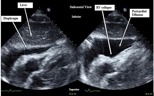 Acute and rapid accumulation of a small amount of pericardial fluid can cause a sudden increase in intrapericardial pressure causing cardiac tamponade.