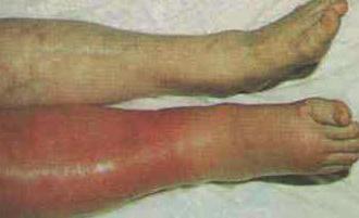 Deep vein thrombosis (DVT) t Swelling of the affected leg t Pain in the affected leg - the