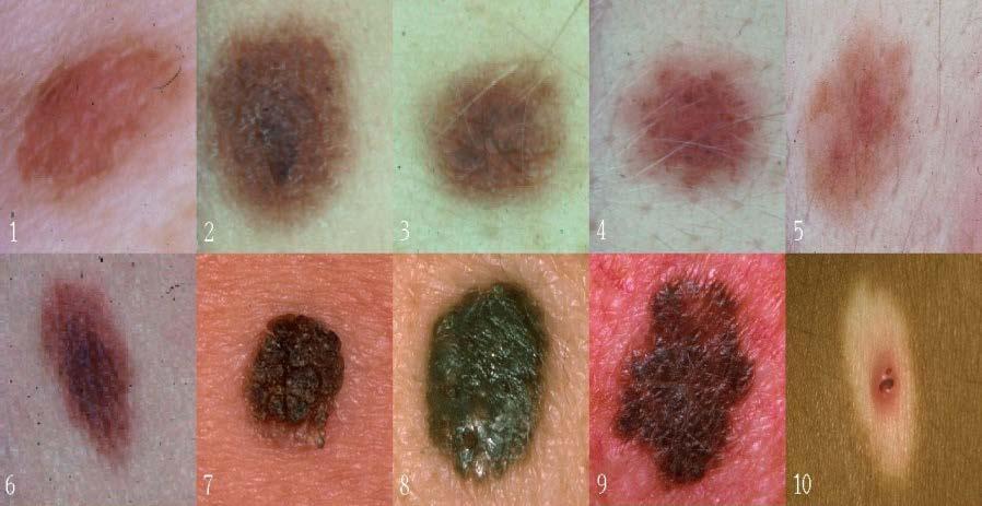 Skin Cancer Over half of all new cancers are skin cancers More than 1 million