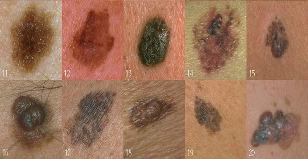 cancers are basal cell carcinoma,16% are squamous cell carcinoma, 4% are