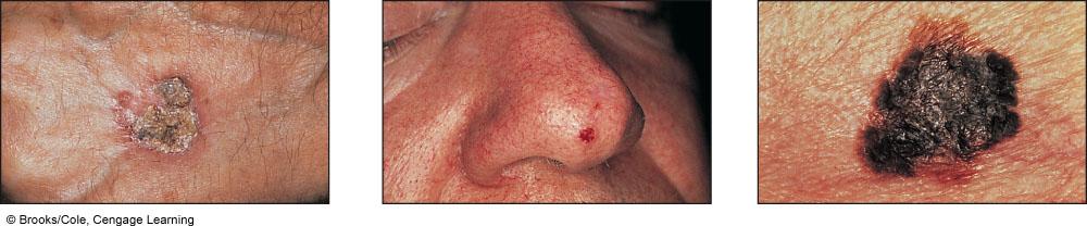 Types of Skin Cancer Squamous Cell Carcinoma Basal Cell Carcinoma Melanoma Arising from cells in the upper layer of the epidermis, this cancer is also caused by exposure to sunlight or tanning lamps.