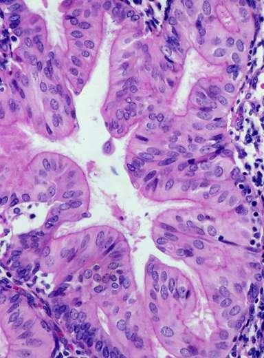 Eosinophilic Metaplasia Very common Eosinophilic, granular cytoplasm usually columnar cells Often
