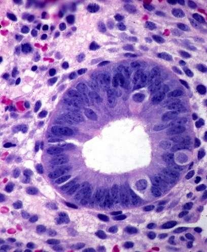 Ciliated Cell Metaplasia Ciliated cells normal in surface endometrium, but not in glands May have nucleomegaly &