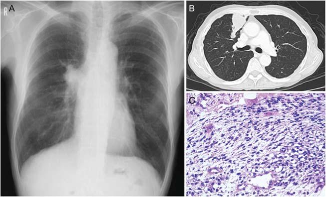 798 Combined LCNEC and spindle cell carcinoma Figure 1. Case 1: pre-operative findings. (A) Chest X-ray film. (B) Chest computed tomography (CT). (C) Histology of the bronchoscopic biopsy specimen.