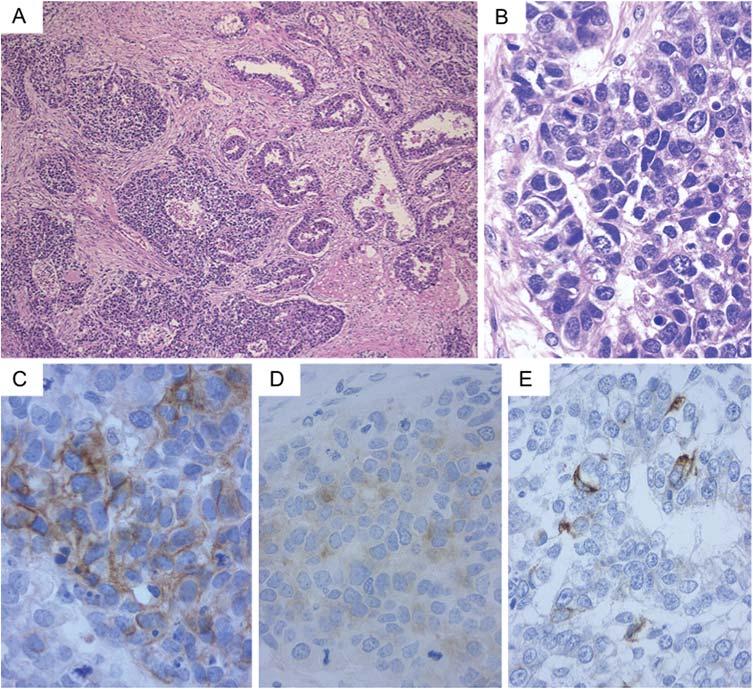 Jpn J Clin Oncol 2011;41(6) 799 Figure 3. Case 1: histological findings of carcinomatous component.