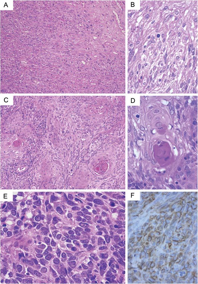 800 Combined LCNEC and spindle cell carcinoma Figure 5. Case 2: histological findings. (A and B) Spindle cell carcinoma component of the tumor. (C and D) Squamous cell carcinoma component.