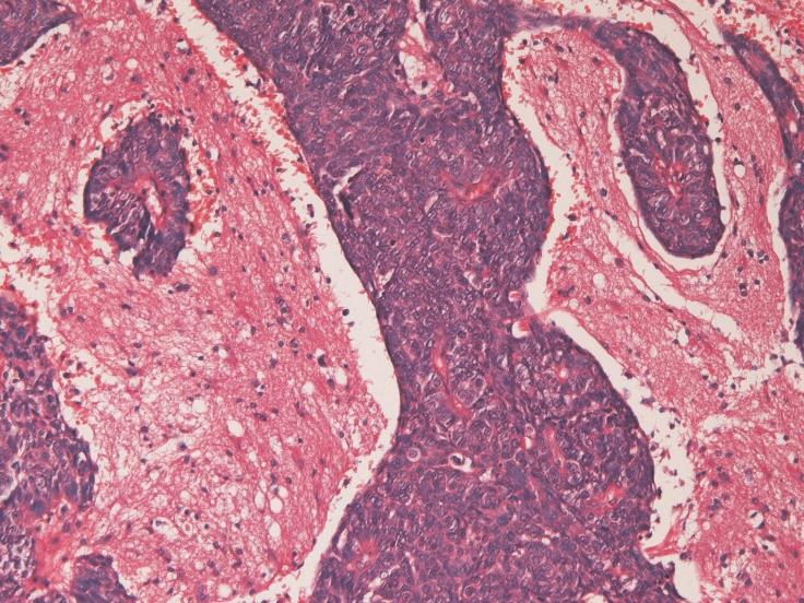 The author herein reports a case of occult very small lung carcinoma presenting as a small solitary brain tumor that was clinically diagnosed as primary brain cavernous hemangioma.
