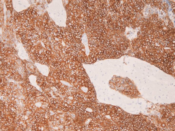 Cases Journal 2009, 2:7475 Figure 3. Cytokeratin 5/6 is strongly expressed in the cytoplasm of the brain tumor. 100. Figure 5.