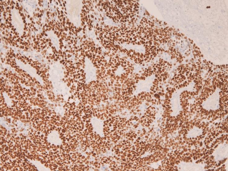 myoblobin, desmin, S100 protein, a-smooth muscle actin, CD34, and CD68 were used for differentiation from carcinomatoid sarcoma.