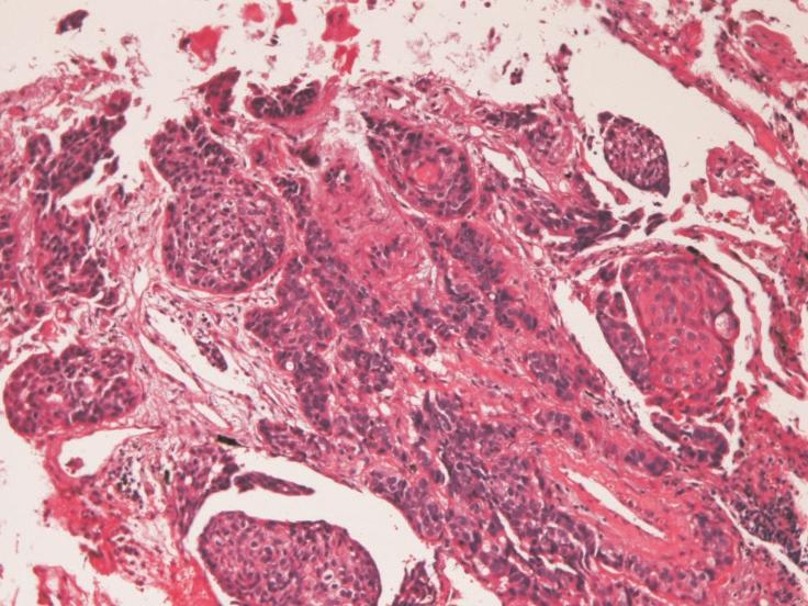 Considering the frequency of metastatic brain tumor and the present immunohistochemical study, the author could suggest that the tumor was lung undifferentiated adenocarcinoma with squamous