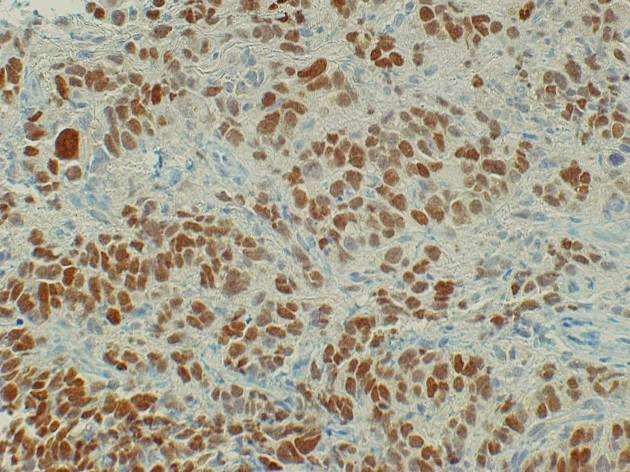 Poorly-differentiated NSCLC?