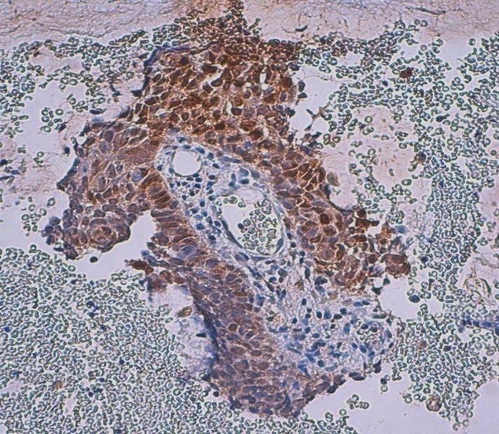 Cell Carcinoma Median (range) Adenocarcinoma Median (range) P value ERCC1 1.41 (0.