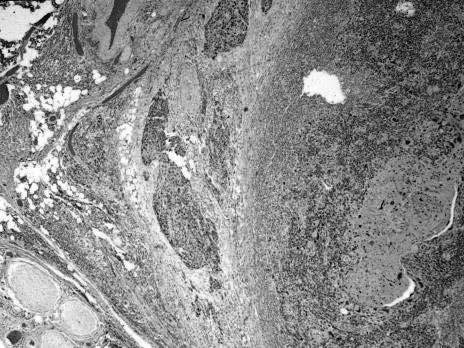 Extension Distant metastasis Angiogenesis; Host immune response Second malignancy Depth of Invasion (DOI) T1: Tumor 2cm & DOI