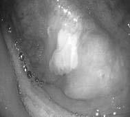 subsites - total size of the leukoplakic foci is >3cm -