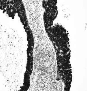 Adenosquamous (Ciliated Cell) Carcinoma p16 p16 Ciliated HPV-Associated Carcinoma (aka Ciliated
