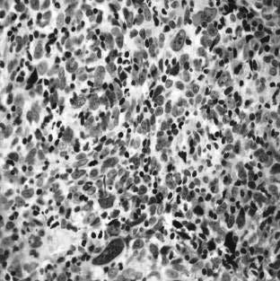 Case Other IHC Hematolymphoid markers (CD45; CD20) negative Melanoma markers