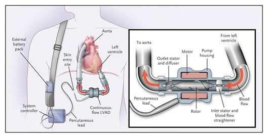 BASIC PRINCIPLES OF LVAD Unlike native heart, do not have the ability to