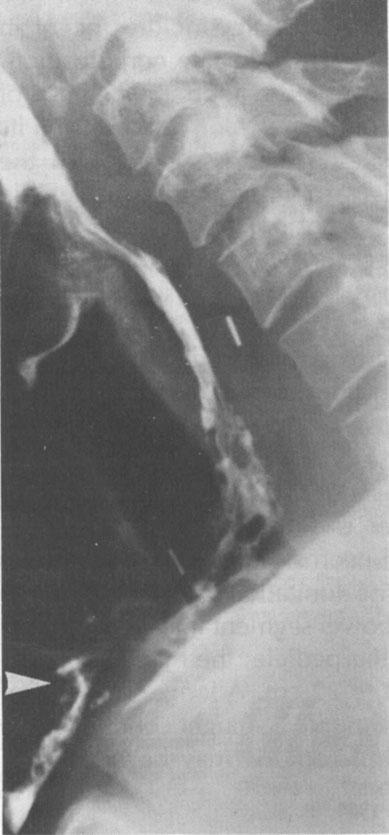 198 ESOPHACEAL RECONSTRUCTION Mayo Clin Proc, March 1984, Vol 59 Barium swallow roentgenography revealed extensive stricture of the hypopharynx and the cervical portion of the esophagus and leakage