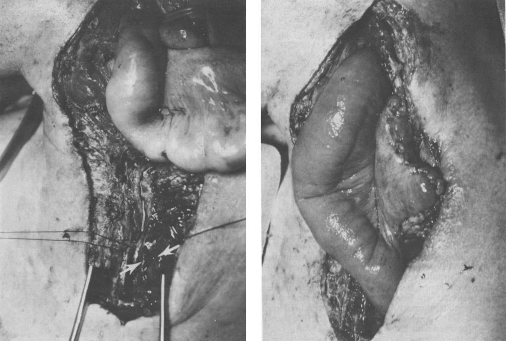 Mayo Clin Proc, March 1984, Vol 59 ESOPHAGEAL RECONSTRUCTION 199 The abdomen was explored, and dilation of the gastric stoma permitted introduction of a DeBakey femoral tun neling device into the