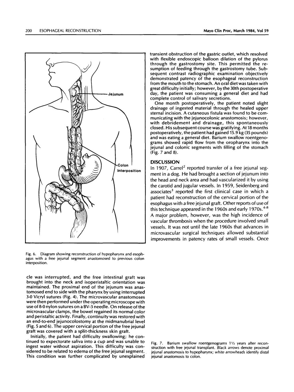 200 ESOPHACEAL RECONSTRUCTION Mayo Clin Proc, March 1984, Vol 59 transient obstruction of the gastric outlet, which resolved with flexible endoscopic balloon dilation of the pylorus through the