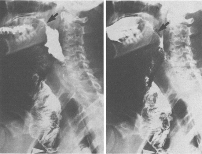 Subsequent contrast radiographic examination objectively demonstrated patency of the esophageal reconstruction from the mouth to the stomach.