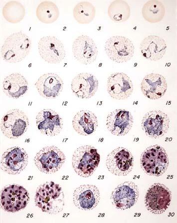 Plasmodium vivax Infected