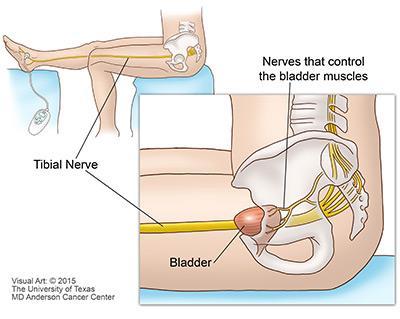 How does PTNS work? Bladder function is regulated by a group of nerves at the base of the spine called the sacral nerve plexus.